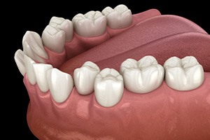 Illustration of crooked teeth