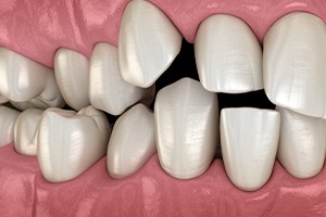 Illustration of spaced-out teeth