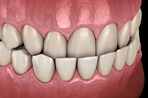 Illustration of an underbite