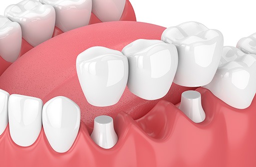 Illustration of a dental bridge levitating above abutments in lower arch with white background