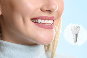 Woman smiling with one tooth indicated as an implant