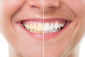 Before and after teeth whitening side by side photo 